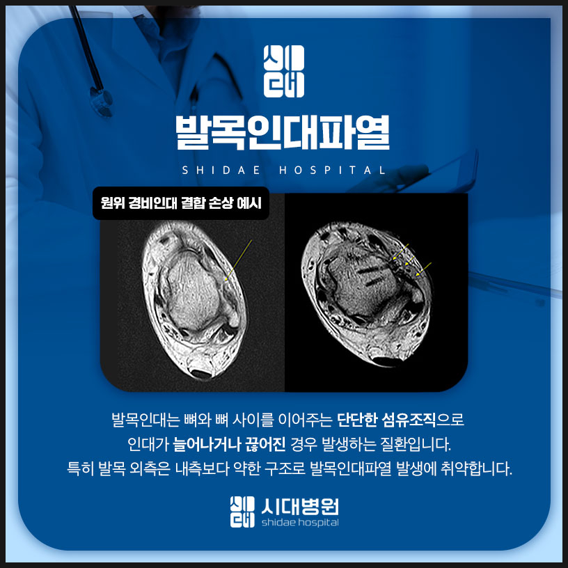 발목 인대 손상 안내